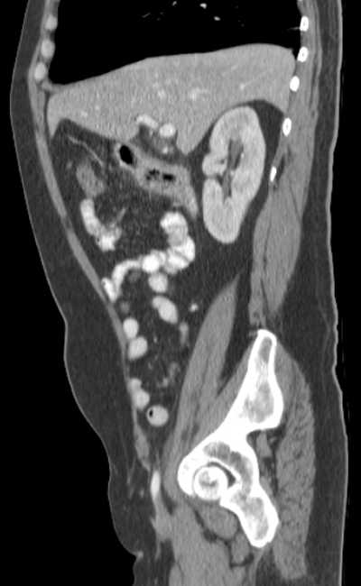 Bleeding duodenal ulcer and adenomyomatosis of gallbladder (Radiopaedia 61834-69861 C 32).jpg