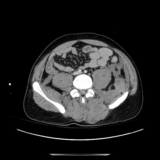 Blunt abdominal trauma with solid organ and musculoskelatal injury with active extravasation (Radiopaedia 68364-77895 A 102).jpg