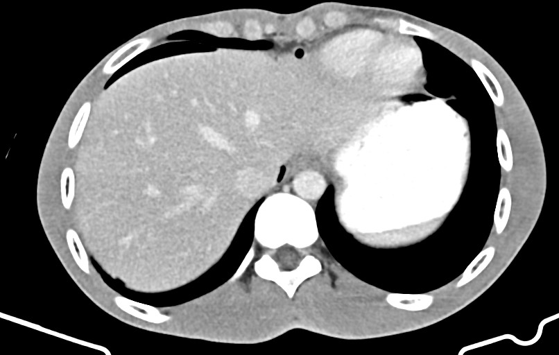 Blunt injury to the small bowel (Radiopaedia 74953-85987 A 5).jpg