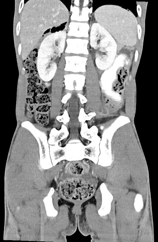 Blunt injury to the small bowel (Radiopaedia 74953-85987 B 69).jpg