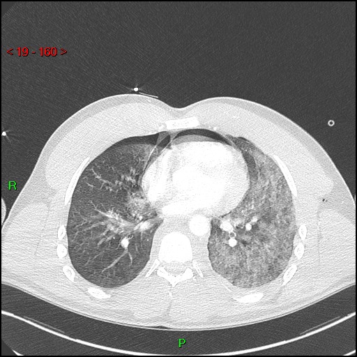 Blunt thoracic trauma (Radiopaedia 73454-84221 Axial lung window 59).jpg