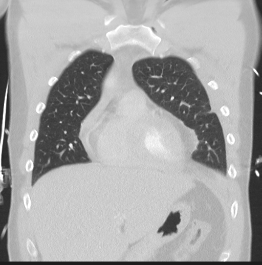 Boerhaave syndrome (Radiopaedia 39382-41661 Coronal lung window 14).png