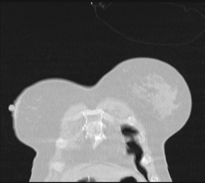 Boerhaave syndrome (Radiopaedia 45644-49799 Coronal lung window 6).jpg