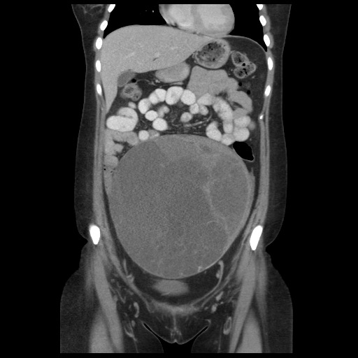 File:Borderline mucinous tumor (ovary) (Radiopaedia 78228-90808 C 19).jpg