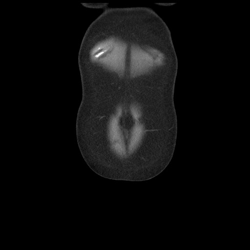 Borderline mucinous tumor (ovary) (Radiopaedia 78228-90808 C 6).jpg