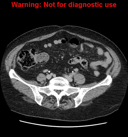 File:Bosniak renal cyst - type II (Radiopaedia 23404-23468 F 44).jpg