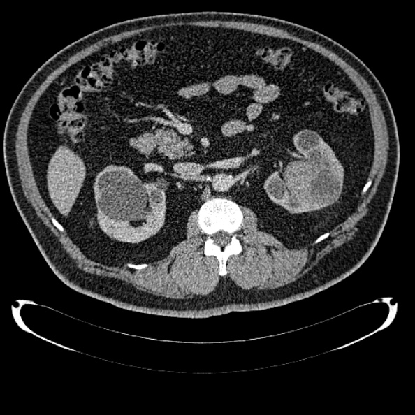 Bosniak renal cyst - type IV (Radiopaedia 24244-24518 C 139).jpg