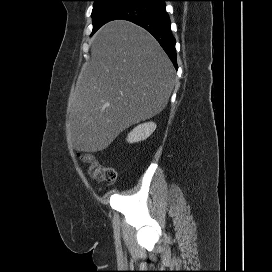 File:Bowel and splenic infarcts in acute lymphocytic leukemia (Radiopaedia 61055-68913 C 59).jpg
