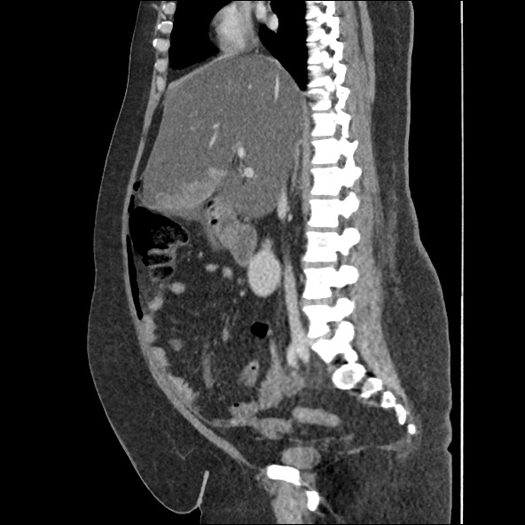 Bowel and splenic infarcts in acute lymphocytic leukemia (Radiopaedia 61055-68915 C 40).jpg