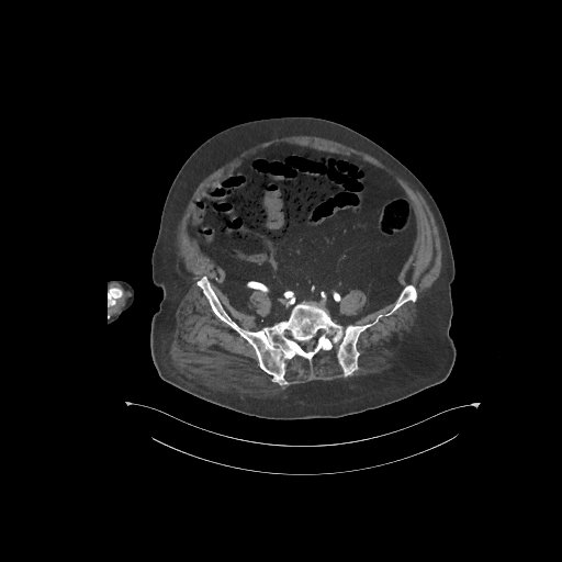 File:Bowel ischemia secondary to SMA occlusion with extensive portomesenteric venous gas (Radiopaedia 54656-60871 A 14).jpg