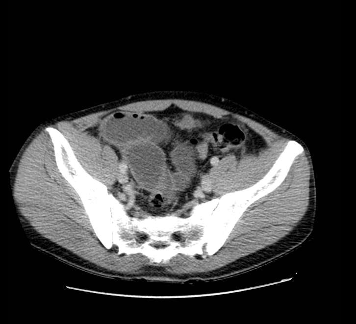 Bowel obstruction from colon carcinoma (Radiopaedia 22995-23028 A 69).jpg