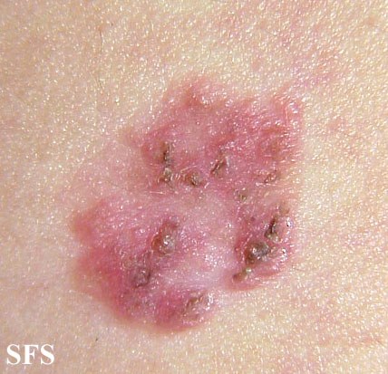Bowen'S Disease (Dermatology Atlas 4).jpg