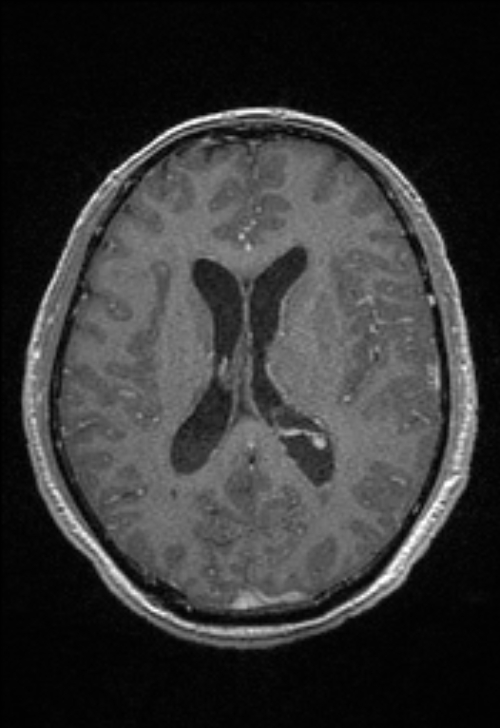 Brain abscess with ventriculitis (Radiopaedia 85703-101495 Axial T1 C+ 105).jpg