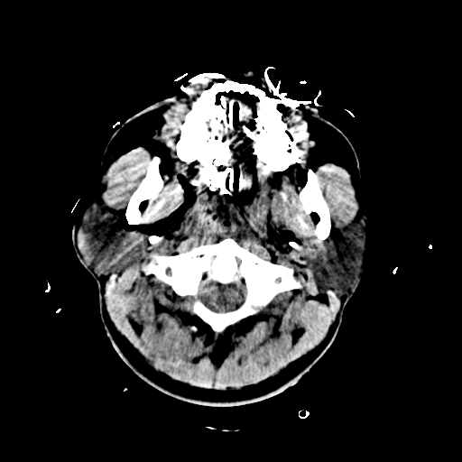 File:Brain contusions, internal carotid artery dissection and base of skull fracture (Radiopaedia 34089-35339 Axial non-contrast 13).png