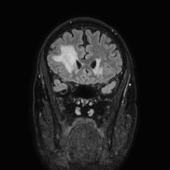 File:Brain metastases from lung cancer (Radiopaedia 83839-99028 Coronal FLAIR 21).jpg