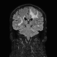 Brain metastases from lung cancer (Radiopaedia 83839-99028 Coronal FLAIR 48).jpg
