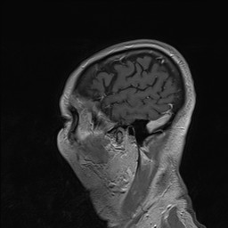 Brain metastasis (Radiopaedia 42617-45761 Sagittal T1 C+ 84).jpg