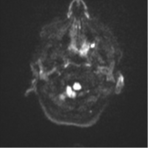 Brain metastasis (sarcoma) (Radiopaedia 47576-52209 Axial DWI 30).png