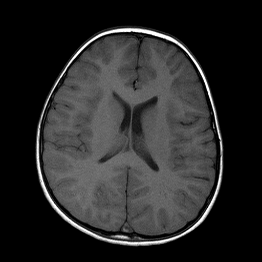 File:Brainstem ganglioglioma (Radiopaedia 10763-11224 Axial T1 8).jpg