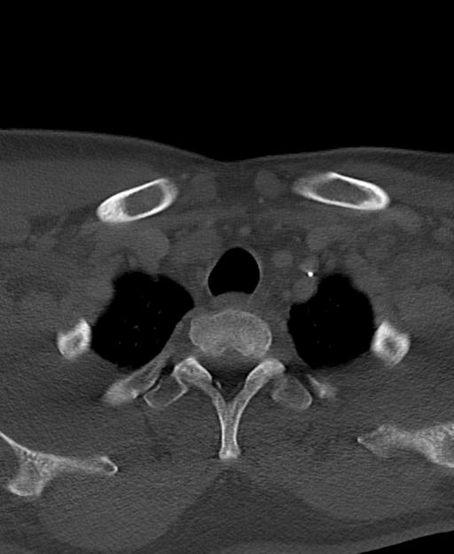Branchial cleft cyst (Radiopaedia 31167-31875 Axial bone window 70).jpg