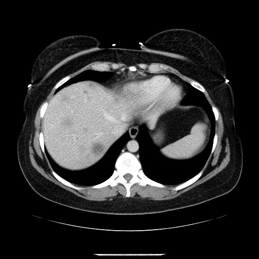 File:Breast cancer pseudocirrhosis after chemotherapy (Radiopaedia 65407-74456 A 14).jpg