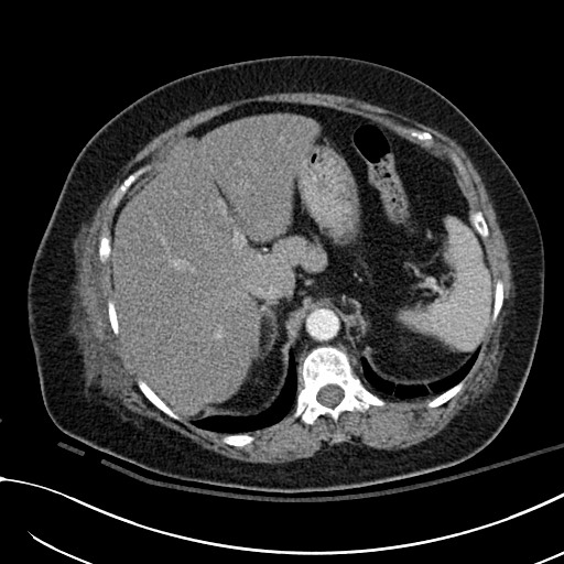 File:Breast carcinoma with pathological hip fracture (Radiopaedia 60314-67974 A 50).jpg