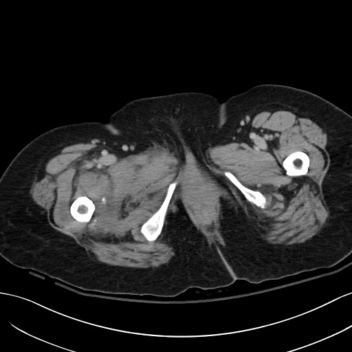 Breast carcinoma with pathological hip fracture (Radiopaedia 60314-67974 B 79).jpg