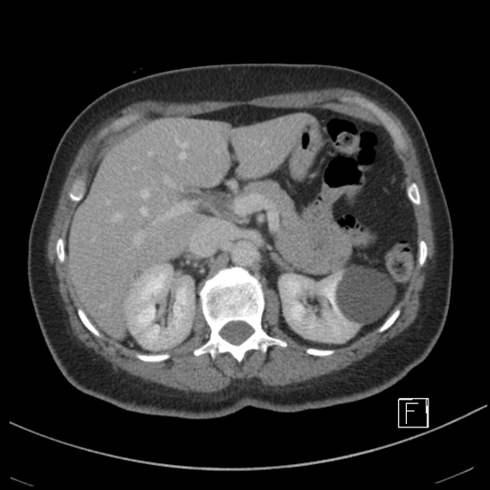 Breast metastases from renal cell cancer (Radiopaedia 79220-92225 C 29).jpg