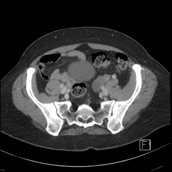 Breast metastases from renal cell cancer (Radiopaedia 79220-92225 C 87).jpg