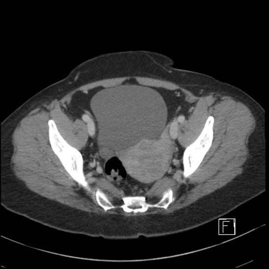 File:Breast metastases from renal cell cancer (Radiopaedia 79220-92225 C 98).jpg