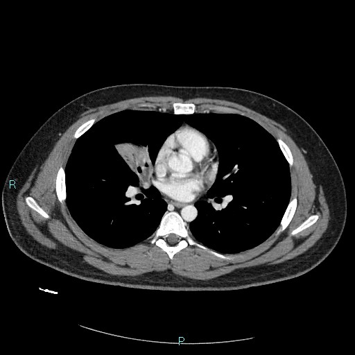 Bronchial carcinoid tumor (Radiopaedia 78272-90875 A 53).jpg