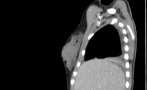 Bronchial mucoepidermoid carcinoma (Radiopaedia 57023-63895 Sagittal 10).jpg
