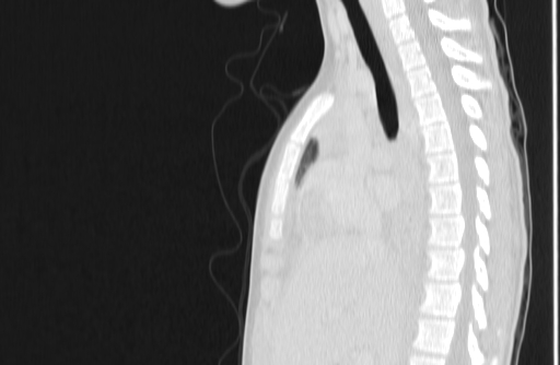 Bronchial mucoepidermoid carcinoma (Radiopaedia 57023-63895 Sagittal lung window 71).jpg