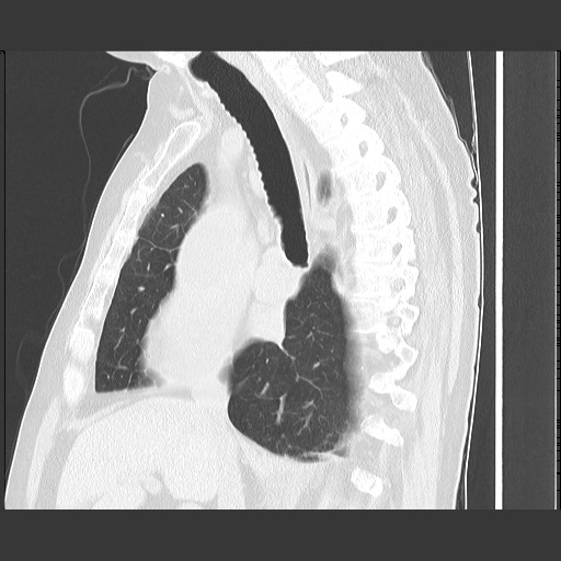 Bronchial stenosis - lung transplant (Radiopaedia 73133-83848 Sagittal lung window 32).jpg