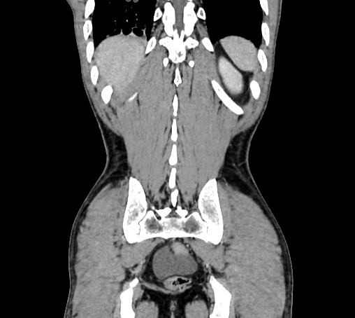 Bronchiectasis in Crohn disease (Radiopaedia 60311-67977 C 74).jpg