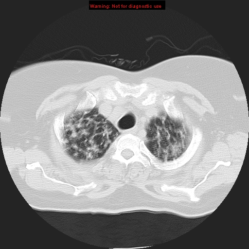 Bronchoalveolar carcinoma (Radiopaedia 13224-13233 Axial lung window 9).jpg