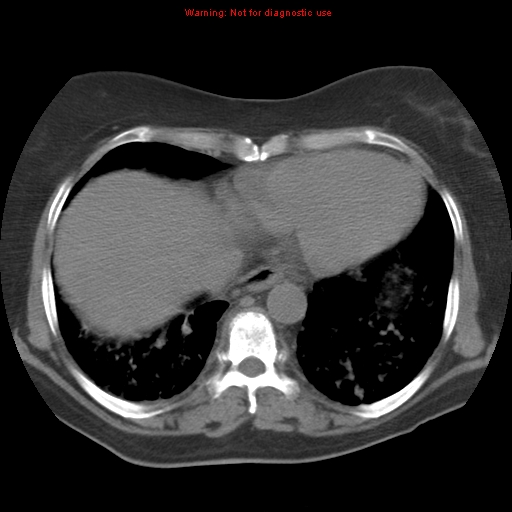 Bronchoalveolar carcinoma (Radiopaedia 13224-13233 Axial non-contrast 33).jpg