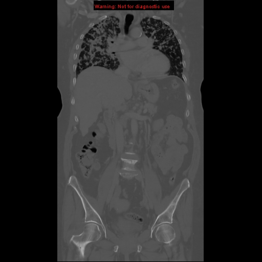 File:Bronchoalveolar carcinoma (Radiopaedia 13224-13233 Coronal non-contrast 7).jpg