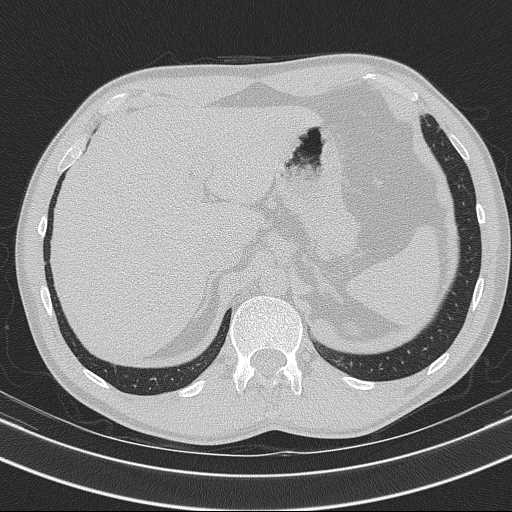 Bronchocele (Radiopaedia 60676-68429 Axial lung window 69).jpg