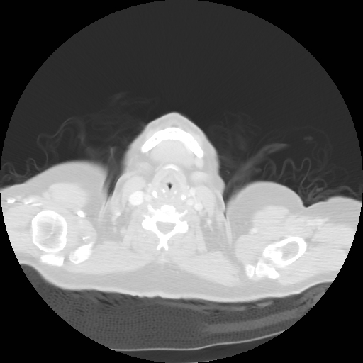 Bronchogenic carcinoma (Radiopaedia 73497-84262 Axial lung window 8).jpg