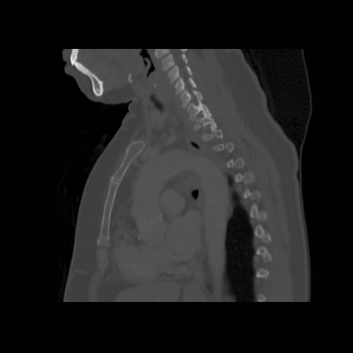 Bronchogenic carcinoma (Radiopaedia 73497-84262 Sagittal bone window 90).jpg