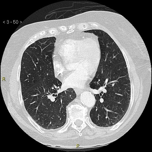 Bronchogenic carcinoma as an incidental finding (Radiopaedia 16453-16130 Axial lung window 50).jpg