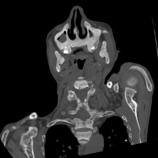 File:Brown tumor with secondary hyperparathyroidism (Radiopaedia 23591-23705 C 26).jpg