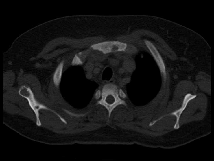 Brown tumors compressing the spinal cord (Radiopaedia 68442-77988 Axial bone window 12).jpg