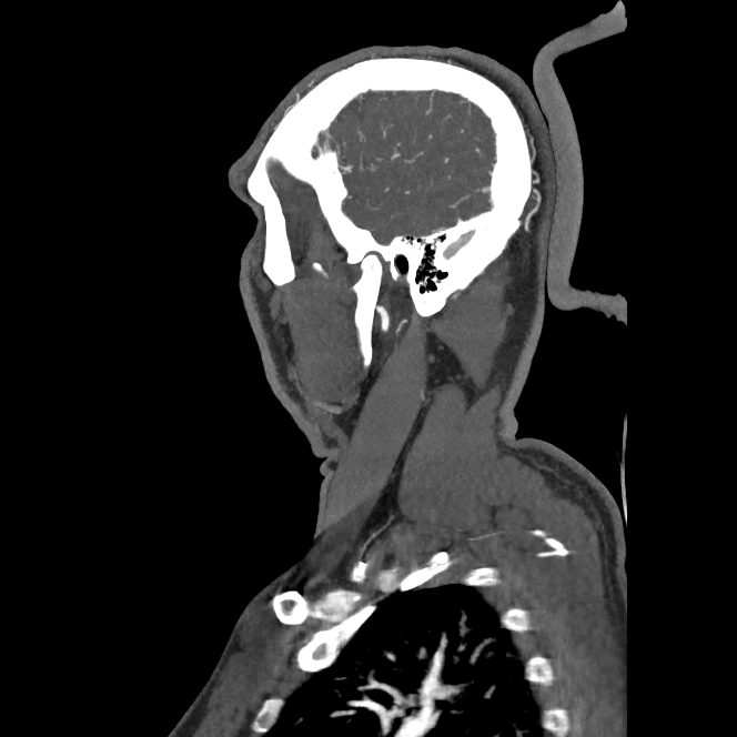 Buccal fat pad arteriovenous malformation (Radiopaedia 70936-81144 C 64).jpg