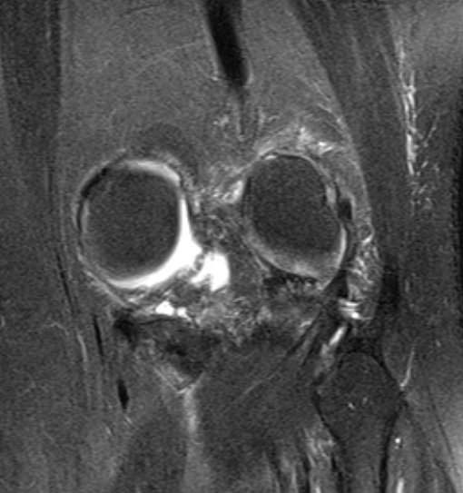 File:Bucket handle tear - medial meniscus (Radiopaedia 79028-91942 Coronal PD fat sat 3).jpg
