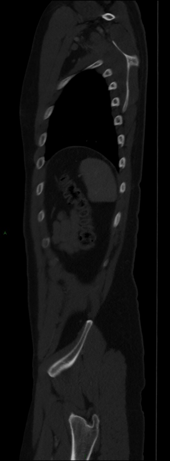 Burst fracture (Radiopaedia 83168-97542 Sagittal bone window 103).jpg