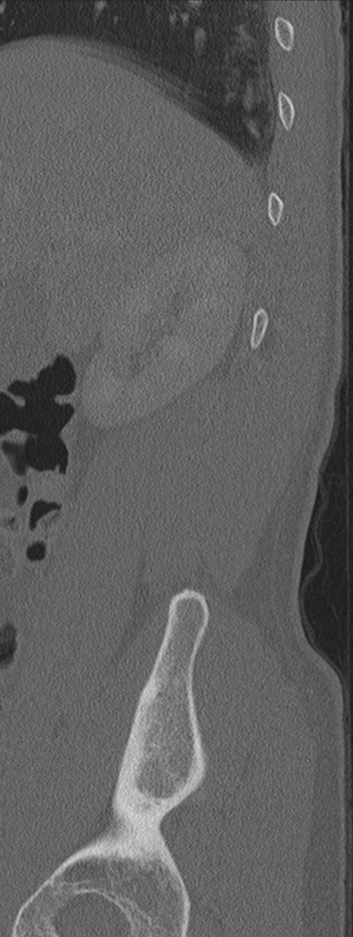 Burst fracture - T12 with conus compression (Radiopaedia 56825-63647 Sagittal bone window 84).png