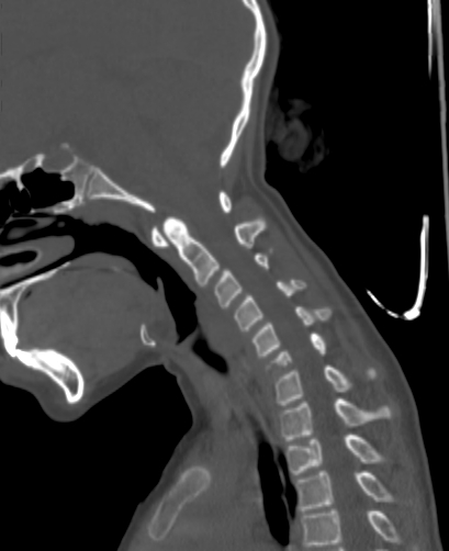 Butterfly vertebra (Radiopaedia 77903-90209 Sagittal bone window 40).jpg