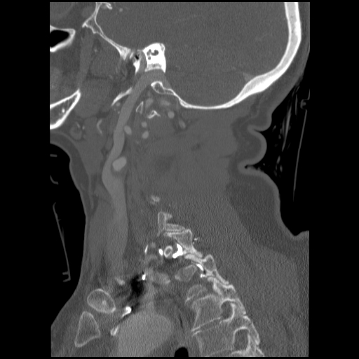 File:C1 anterior arch (plough) fracture - type 1 (Radiopaedia 76181-87720 Sagittal bone window 36).jpg